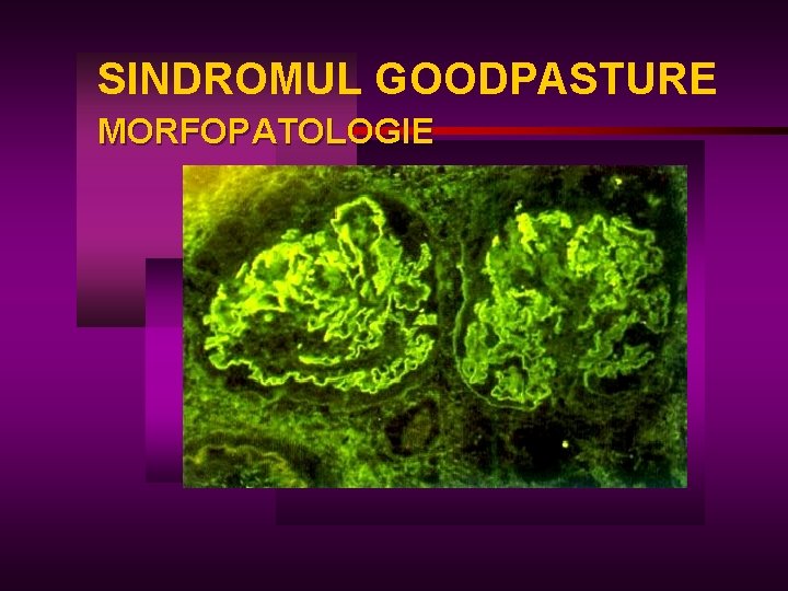 SINDROMUL GOODPASTURE MORFOPATOLOGIE 
