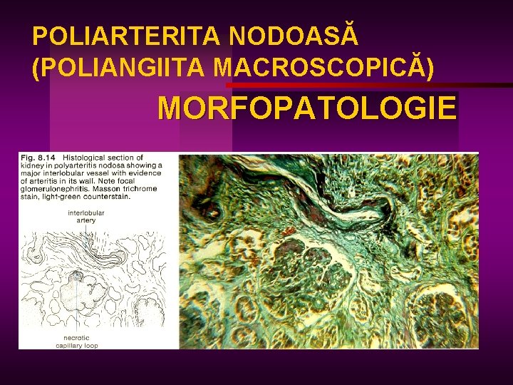POLIARTERITA NODOASĂ (POLIANGIITA MACROSCOPICĂ) MORFOPATOLOGIE 
