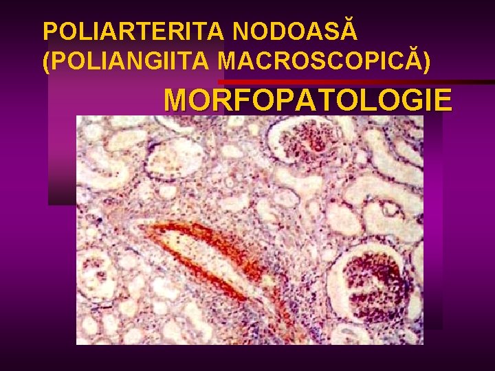 POLIARTERITA NODOASĂ (POLIANGIITA MACROSCOPICĂ) MORFOPATOLOGIE 