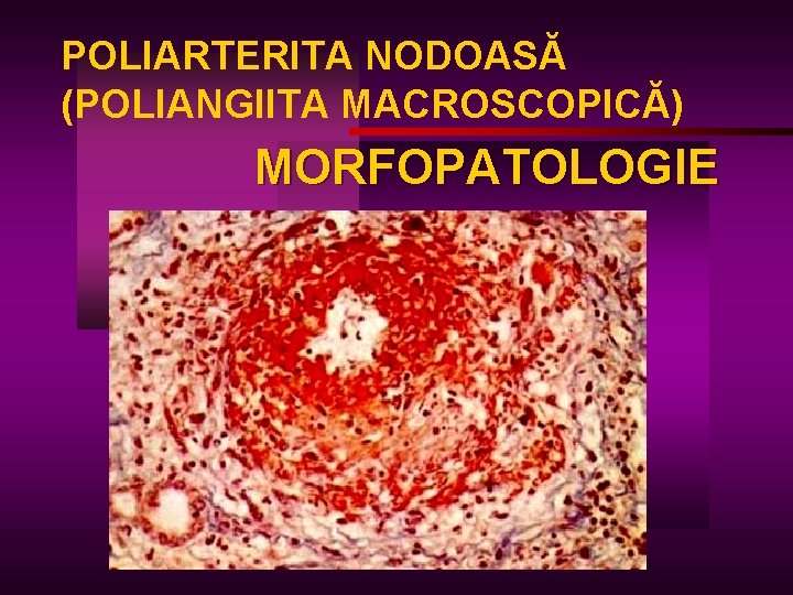 POLIARTERITA NODOASĂ (POLIANGIITA MACROSCOPICĂ) MORFOPATOLOGIE 