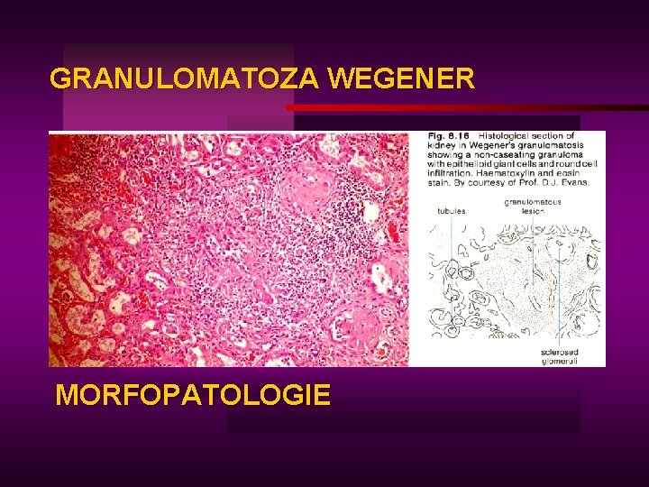 GRANULOMATOZA WEGENER MORFOPATOLOGIE 