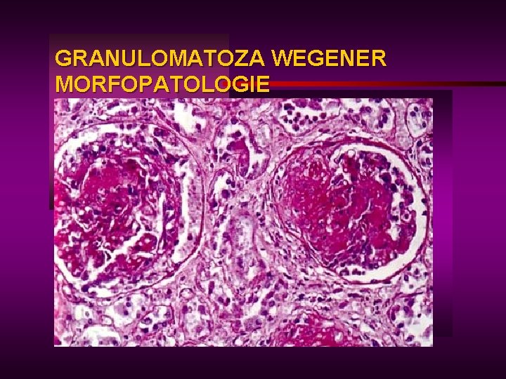 GRANULOMATOZA WEGENER MORFOPATOLOGIE 