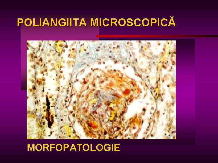 POLIANGIITA MICROSCOPICĂ MORFOPATOLOGIE 