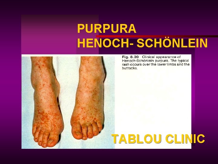 PURPURA HENOCH- SCHÖNLEIN TABLOU CLINIC 