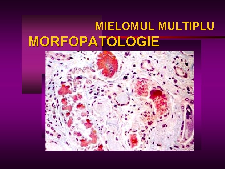 MIELOMUL MULTIPLU MORFOPATOLOGIE 