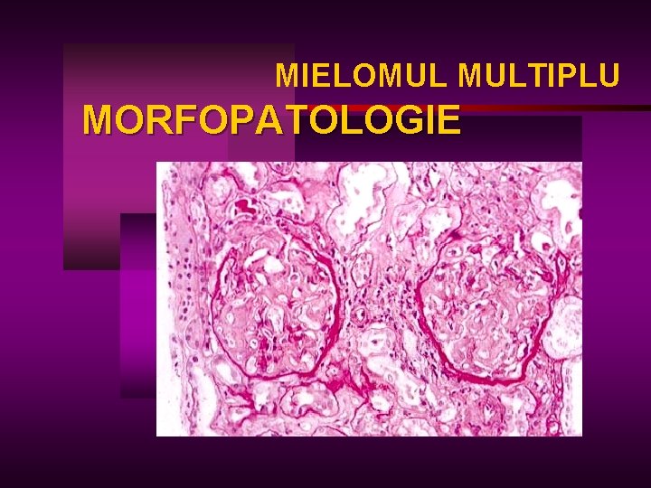 MIELOMUL MULTIPLU MORFOPATOLOGIE 