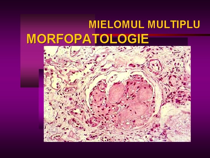 MIELOMUL MULTIPLU MORFOPATOLOGIE 
