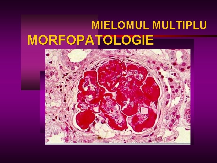MIELOMUL MULTIPLU MORFOPATOLOGIE 