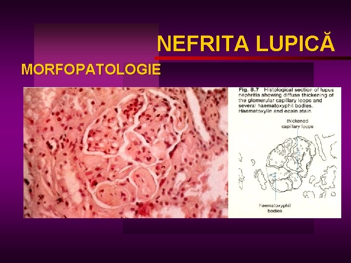 NEFRITA LUPICĂ LUPIC MORFOPATOLOGIE 