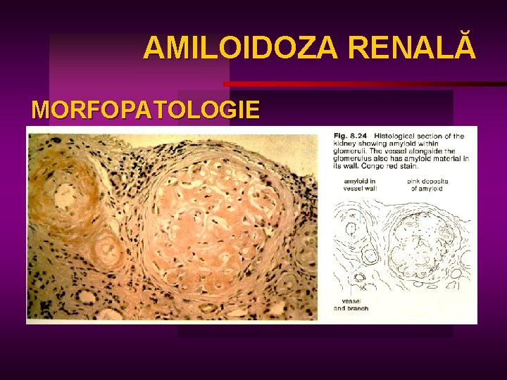 AMILOIDOZA RENALĂ AM MORFOPATOLOGIE 