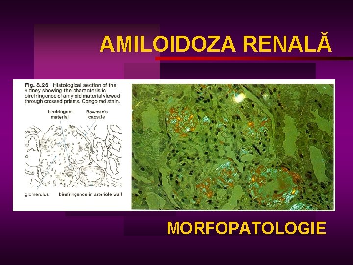 AMILOIDOZA RENALĂ AM MORFOPATOLOGIE 