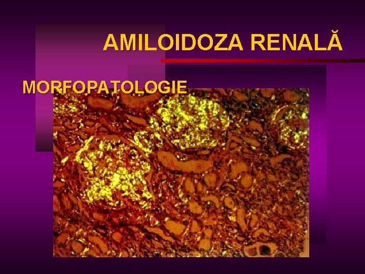 AMILOIDOZA RENALĂ AM MORFOPATOLOGIE 