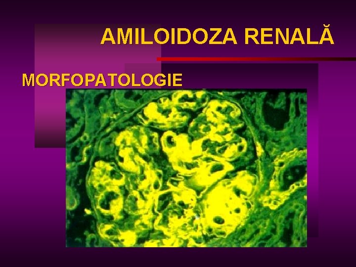 AMILOIDOZA RENALĂ AM MORFOPATOLOGIE 