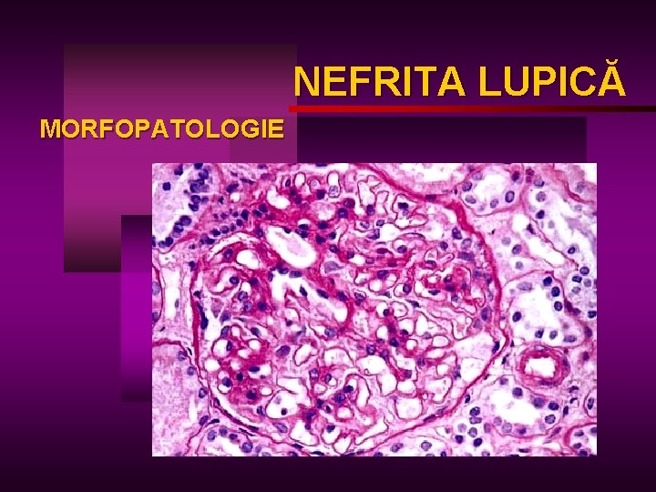 NEFRITA LUPICĂ LUPIC MORFOPATOLOGIE 