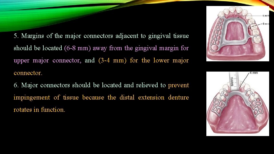 5. Margins of the major connectors adjacent to gingival tissue should be located (6
