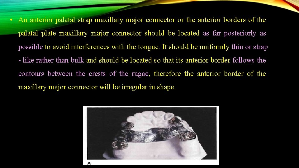  • An anterior palatal strap maxillary major connector or the anterior borders of