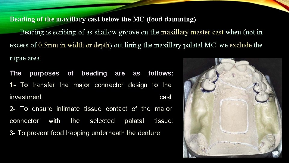 Beading of the maxillary cast below the MC (food damming) Beading is scribing of