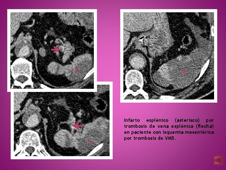 * * * Infarto esplénico (asterisco) por trombosis de vena esplénica (flecha) en paciente