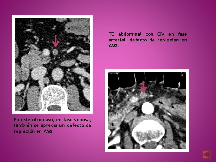 TC abdominal con CIV en fase arterial: defecto de repleción en AMS. En este