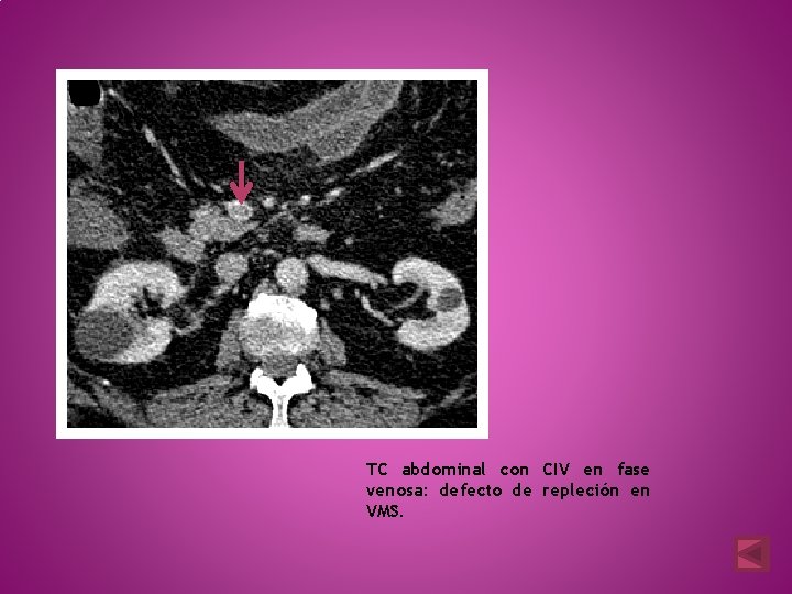 TC abdominal con CIV en fase venosa: defecto de repleción en VMS. 