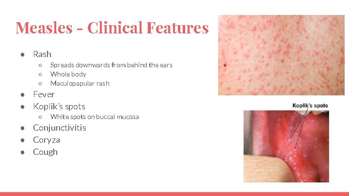 Measles - Clinical Features ● Rash ○ ○ ○ Spreads downwards from behind the