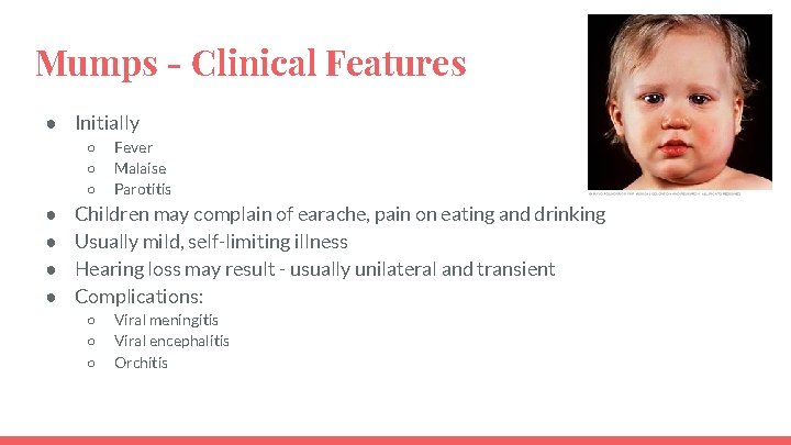 Mumps - Clinical Features ● Initially ○ ○ ○ ● ● Fever Malaise Parotitis