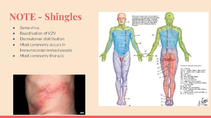 NOTE - Shingles ● ● ● Same virus Reactivation of VZV Dermatomal distribution Most