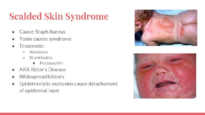 Scalded Skin Syndrome ● Cause: Staph Aureus ● Toxin causes syndrome ● Treatment: ○