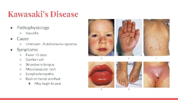 Kawasaki’s Disease ● Pathophysiology ○ Vasulitis ● Cause ○ Unknown - Autoimmune repsonse ●