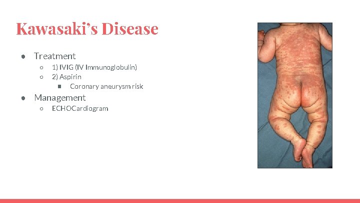 Kawasaki’s Disease ● Treatment ○ ○ 1) IVIG (IV Immunoglobulin) 2) Aspirin ■ Coronary