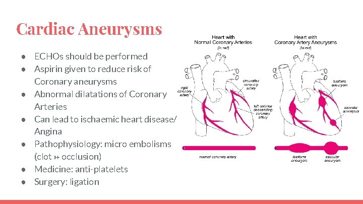 Cardiac Aneurysms ● ECHOs should be performed ● Aspirin given to reduce risk of