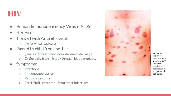 HIV ● Human Immunodeficiency Virus → AIDS ● HIV Virus ● Treated with Antiretrovirals