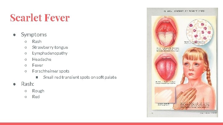 Scarlet Fever ● Symptoms ○ ○ ○ Rash Strawberry tongue Lymphadenopathy Headache Fever Forschheimer