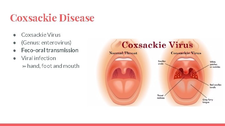 Coxsackie Disease ● ● Coxsackie Virus (Genus: enterovirus) Feco-oral transmission Viral infection → hand,