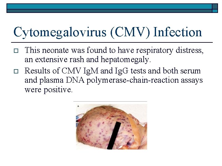 Cytomegalovirus (CMV) Infection o o This neonate was found to have respiratory distress, an