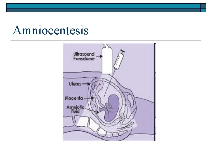 Amniocentesis 