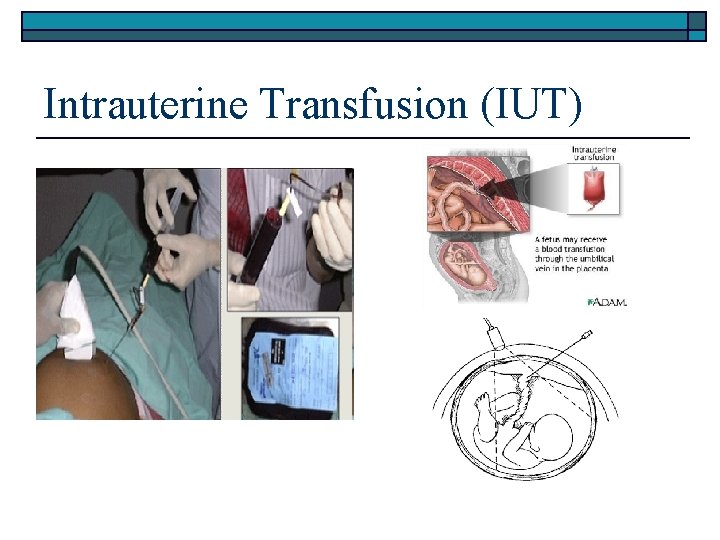 Intrauterine Transfusion (IUT) 