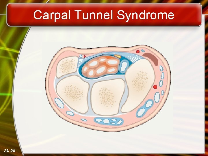 Carpal Tunnel Syndrome 3 A-20 