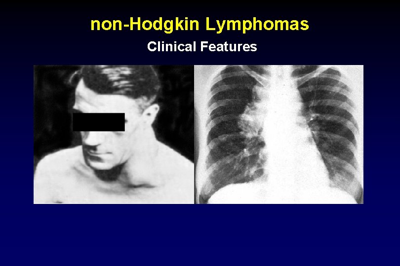 non-Hodgkin Lymphomas Clinical Features 