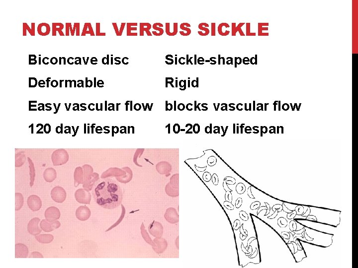 NORMAL VERSUS SICKLE Biconcave disc Sickle-shaped Deformable Rigid Easy vascular flow blocks vascular flow