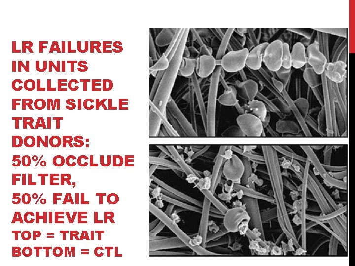 LR FAILURES IN UNITS COLLECTED FROM SICKLE TRAIT DONORS: 50% OCCLUDE FILTER, 50% FAIL