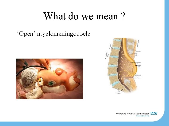 What do we mean ? ‘Open’ myelomeningocoele 