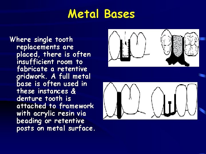 Metal Bases Where single tooth replacements are placed, there is often insufficient room to