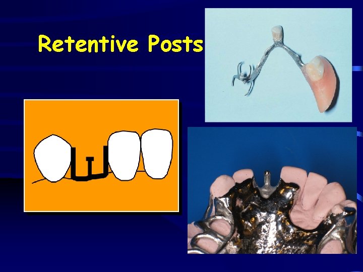 Retentive Posts 