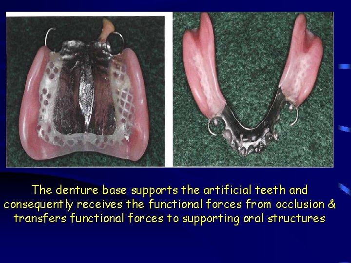 The denture base supports the artificial teeth and consequently receives the functional forces from