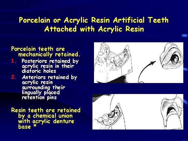 Porcelain or Acrylic Resin Artificial Teeth Attached with Acrylic Resin Porcelain teeth are mechanically