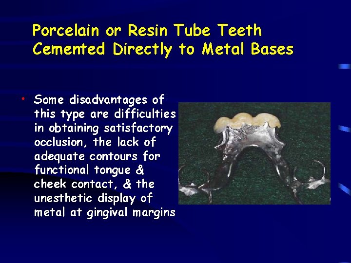 Porcelain or Resin Tube Teeth Cemented Directly to Metal Bases • Some disadvantages of