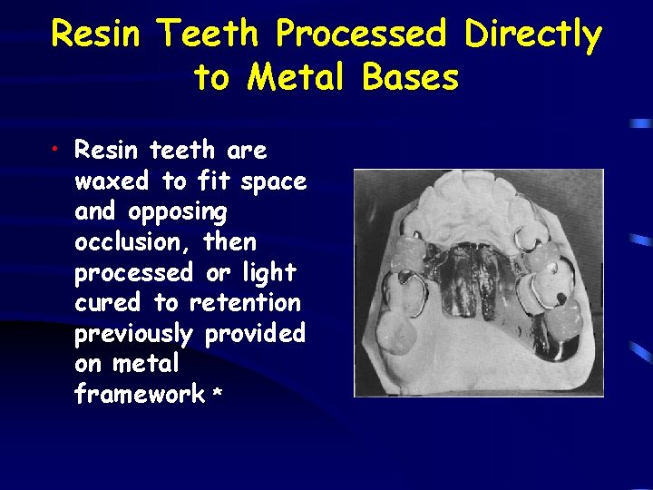 Resin Teeth Processed Directly to Metal Bases • Resin teeth are waxed to fit