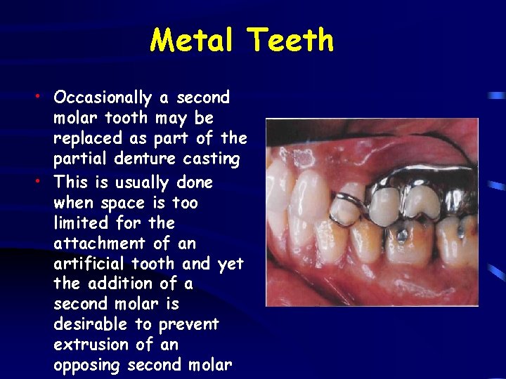 Metal Teeth • Occasionally a second molar tooth may be replaced as part of