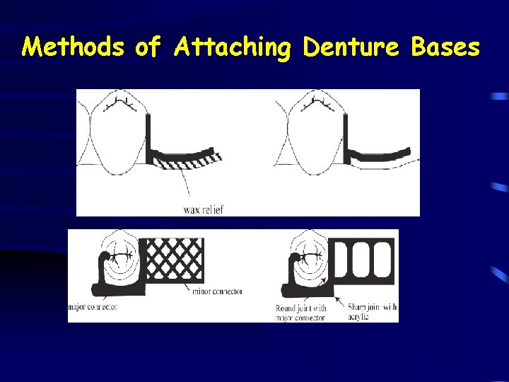 Methods of Attaching Denture Bases 